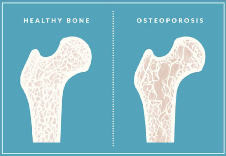 Osteoporosis Screening